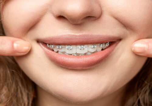 curly hair woman with brackets