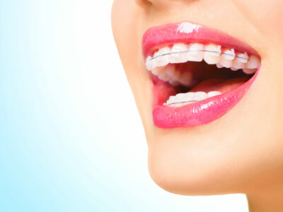 Beautiful woman smiling. Closeup ceramic braces on teeth